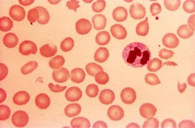 Peripheral blood of a child with disseminated intr