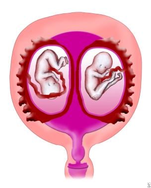 Dichorionic/diamniotic placentation. 