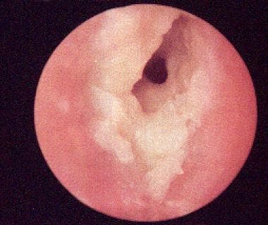 Acute otitis externa. Ear canal is red and edemato