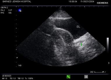 Sagittal viewing showing bladder, uterus (behind t