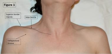 subclavian vein central line landmarks