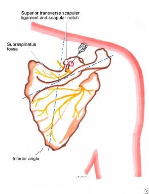 Suprascapular nerve block technique. See text for 