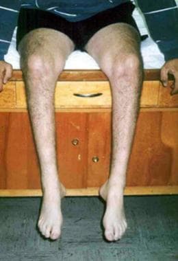 Example of Charcot-Marie-Tooth disease (ie, perone