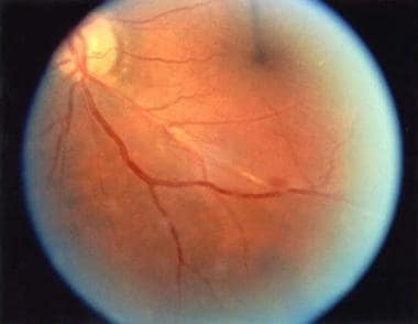 Platelet/fibrin embolus producing a branch retinal