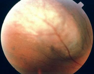 Color photograph of a dome-shaped choroidal melano