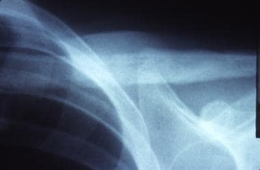 Anteroposterior radiograph of the left clavicle re