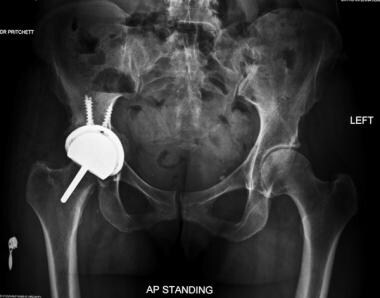 Evolution of mould arthroplasty of the hip joint.