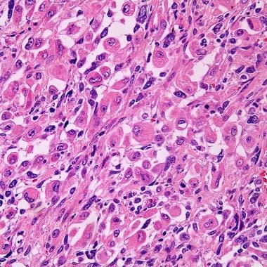 Rhabdomyoblasts may be seen in carcinosarcoma and 