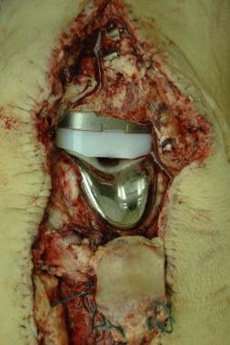 A knee replacement prosthesis in situ at autopsy, 