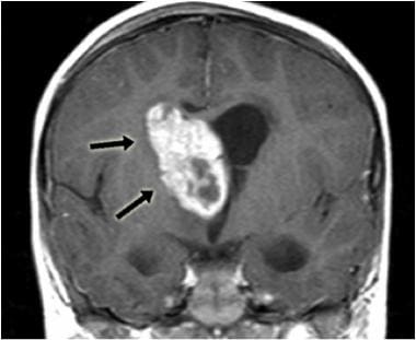 MRI image of subependymal giant cell astrocytoma/s