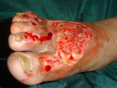 Debridement of venous ulcer on foot. 