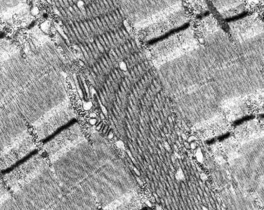 Tubular aggregate myopathy, electron micrograph. A