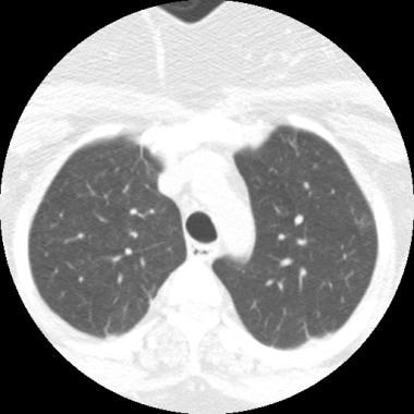 Dynamic CT scan of chest during inspiration in nor