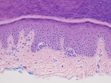 Acral junctional melanocytic nevus with nests of b