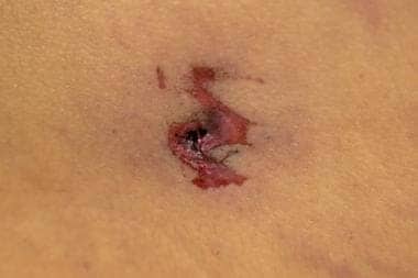Exit wound with "shoring." Note the prominent, mar