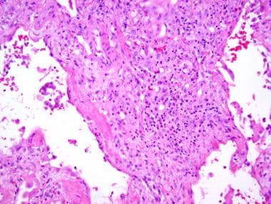 Organizing diffuse alveolar damage (DAD). Remnants
