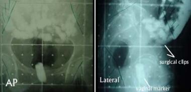 Radiation dose and incidence of new metastasis in the anterior