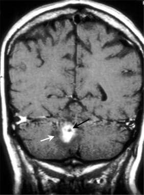 Brain abscess. Coronal T1-weighted spin-echo gadol