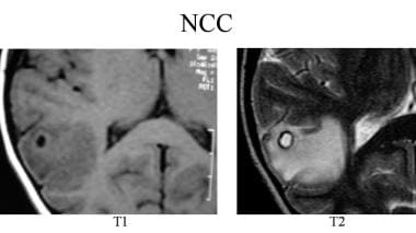 T1-weighted (T1) and T2-weighted (T2) MRIs show a 