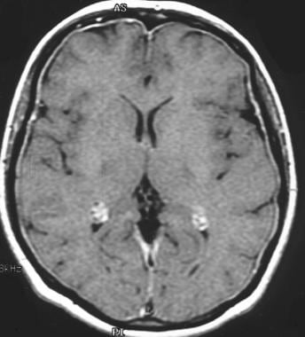 Pachymeningitis in a patient with bacterial mening