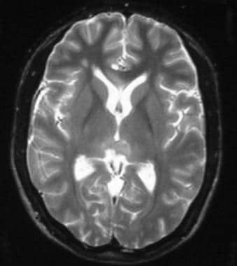 Pineal germinoma in a 19-year-old man. Axial T2-we