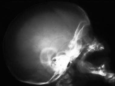 Lateral skull radiograph shows the normal bilatera