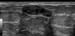 Breast Fibroadenoma Imaging
