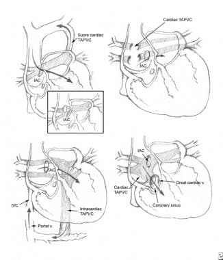 Anomalous pulmonary venous return (APVR). Types of