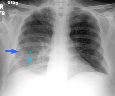 chest x ray pleural effusion