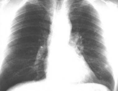 Thoracic histoplasmosis. A chest radiograph in a 4