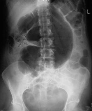 This plain supine radiograph was obtained 24 hours