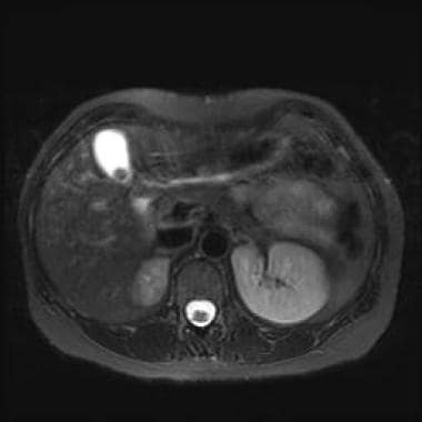 Cholelithiasis. Typical appearance of a gallstone 