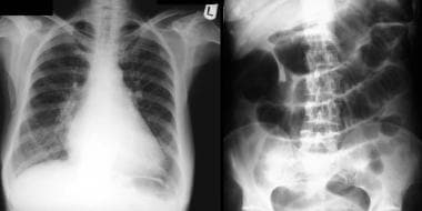Left: Chest radiograph of a 45-year-old woman with