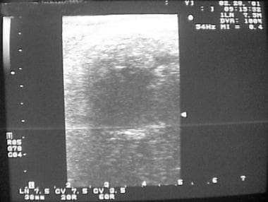 Intraoperative sonogram of a pancreatic pseudocyst
