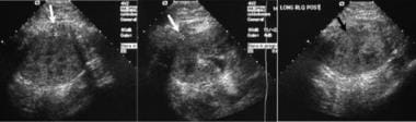 Renal sonography is helpful in localization of a s