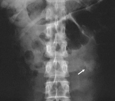 Plain abdominal radiograph in a 30-year-old woman 
