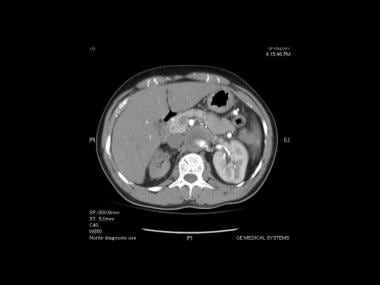 Image of a 39-year-old man with Leriche syndrome. 