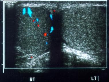 Testicular torsion. Transverse color Doppler image