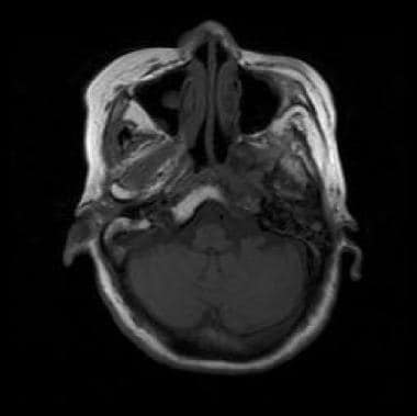 Nonenhanced T1-weighted MRI shows nasopharyngeal c