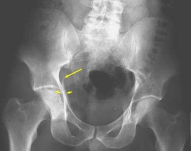 Anterior column fracture with a posterior hemitran