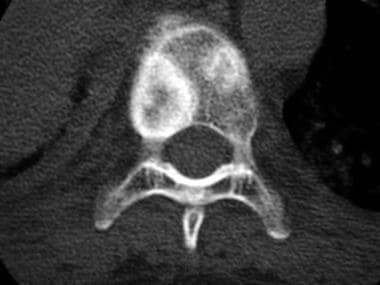 Axial computed tomography scan shows 2 rounded, mi