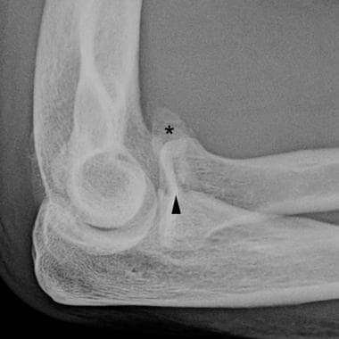 Elbow, fractures and dislocations. Coronoid proces
