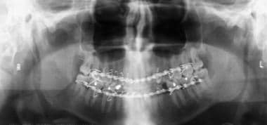Panoramic radiographic image that was obtained aft