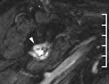 Oblique sagittal T2-weighted fat-suppression image