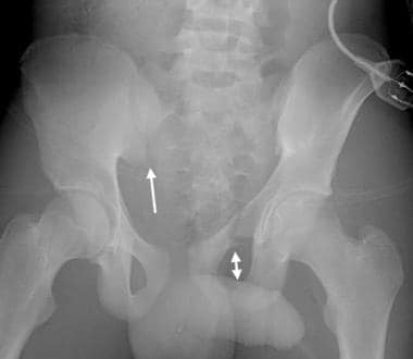 Windswept pelvis or lateral compression III injury