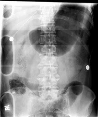 Abdominal radiograph. This image demonstrates mode