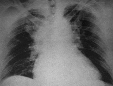 Supine frontal radiograph after significant blunt 