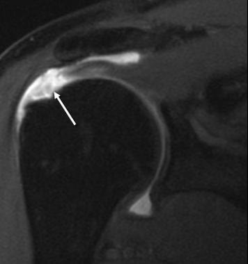 torn rotator cuff mri