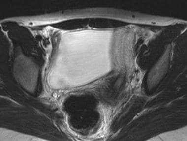 Uterus, müllerian duct abnormalities. Unicornuate 