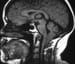 Chiari I Malformation (CMI) Imaging